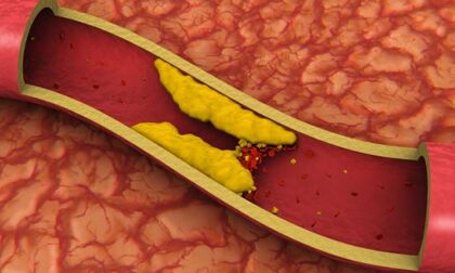 Las emisiones del diésel aumenta el nivel del colesterol malo