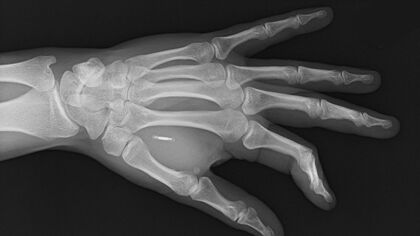 Se implanta la llave de su Tesla en su cuerpo